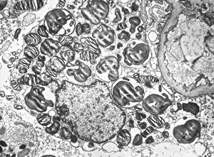 M,27y. | sea-blue histiocyte syndrome M,27y. | sea-blue histiocyte syndrome